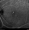 Filename=Idiopathic-CNVM_081221_anvir_24.jpg
Filesize=210KiB
Dimensions=1536x1636
Date added=Aug 19, 2021 Idiopathic-CNVM_081221_anvir_24.jpg