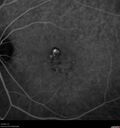 Filename=Idiopathic-CNVM_081221_anvir_25.jpg
Filesize=188KiB
Dimensions=1536x1636
Date added=Aug 19, 2021 Idiopathic-CNVM_081221_anvir_25.jpg