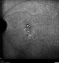 Filename=Idiopathic-CNVM_081221_anvir_26.jpg
Filesize=361KiB
Dimensions=1536x1636
Date added=Aug 19, 2021 Idiopathic-CNVM_081221_anvir_26.jpg