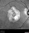 MacLaserScar-pohs_jolin_012617_06.jpg