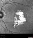 MacLaserScar-pohs_jolin_012617_07.jpg