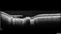 MacLaserScar-pohs_jolin_012617_12.jpg