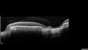 MacLaserScar-pohs_jolin_012617_13.jpg