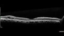 NPDR-non-perfusion_103200_082024_03.jpg