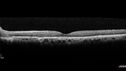 NPDR-non-perfusion_103200_082024_04.jpg