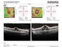 PDR-DME-Pregnancy_shdor1_042021_07.JPG
