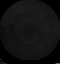 PDR-DME-Pregnancy_shdor1_042021_15.jpg