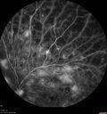PDR-DME-Pregnancy_shdor1_042021_26.jpg