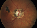 POHS_ancer_061617_02.png