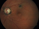 POHS_ancer_061617_03.png