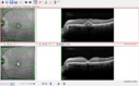 PatternDystrophy_96645_fu_21.PNG