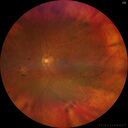 RP-RHOmutation_suric_073020_02.jpg