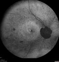 RP-RHOmutation_suric_073020_03.jpg