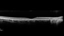RP-RHOmutation_suric_073020_05.jpg