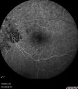 Filename=Radiation_Retinopathy_Both_Eyes_-_2023_-_Two_years_after_radiation_for_ocular_lymphoma__281529.jpg
Filesize=112KiB
Dimensions=768x868
Date added=Aug 21, 2023 Radiation_Retinopathy_Both_Eyes_-_2023_-_Two_years_after_radiation_for_ocular_lymphoma__281529.jpg
