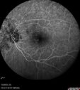 Radiation_Retinopathy_Both_Eyes_-_2023_-_Two_years_after_radiation_for_ocular_lymphoma__281729.jpg