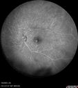 Radiation_Retinopathy_Both_Eyes_-_2023_-_Two_years_after_radiation_for_ocular_lymphoma__282029.jpg