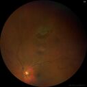 Tear_laser_liwil_01.jpg