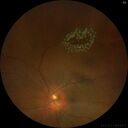 Tear_laser_liwil_03.jpg