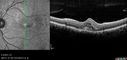 angioidS_miba_051915_16.jpg