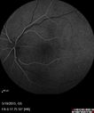 angioidS_miba_051915_18.jpg