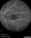 angioidS_miba_051915_21.jpg