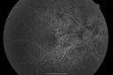 angioidstreakrolo_281029.png