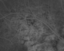 angioidstreakrolo_281129.png