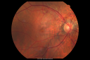 angioidstreakrolo_28129.png
