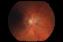 angioidstreakrolo_28229.png