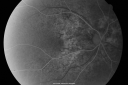 angioidstreakrolo_28729.png