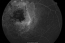 angioidstreakrolo_28829.png