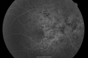 angioidstreakrolo_28929.png
