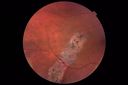 csr-OD-asymptomatic-goodva_28629.JPG