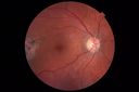 csr-OD-asymptomatic-goodva_28729.JPG