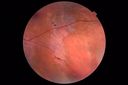 csr-OS-asymptomatic-goodva_28729.JPG