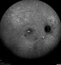 csr_fibrin21_mada_050117_32.jpg