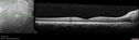 discedema-post-carotid-endarterectomy-mides_03.jpg