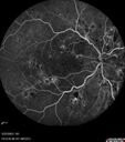 dme_htn-choroid_padod1_052523_22.jpg