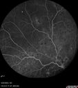 dme_htn-choroid_padod1_052523_23.jpg