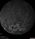 dme_htn-choroid_padod1_052523_24.jpg