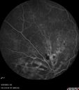 dme_htn-choroid_padod1_052523_31.jpg