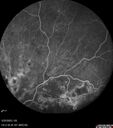 dme_htn-choroid_padod1_052523_32.jpg