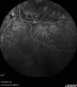 dme_htn-choroid_padod1_052523_34.jpg
