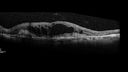 drusen-cnvm_dasou1_061322_06.jpg