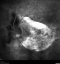 drusen-cnvm_dasou1_061322_16.jpg