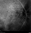 drusen-cnvm_dasou1_061322_20.jpg