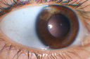 irisnevus1.png
