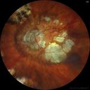 myopicCNVM1_861016_02132023_04.jpg