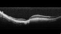 myopicCNVM1_861016_02132023_08.jpg